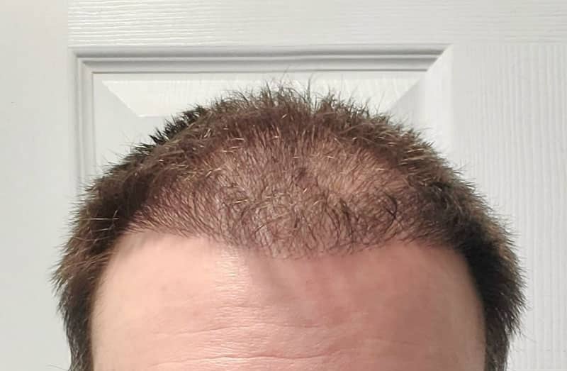 What Does 100 Hairs Look Like Best Hair Transplant